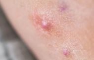 An image of skin presenting Hidradenitis Suppurativa